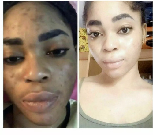 Dark skin bleaching - dark,