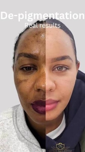 Fast skin whitening - skin, bleaching